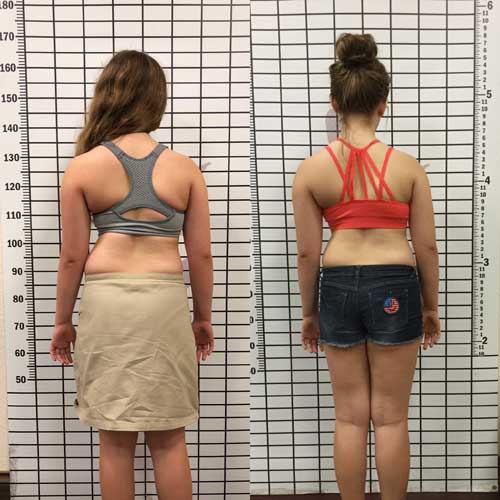 Girl with Scoliosis showing improvement with Schroth Method Therapy.