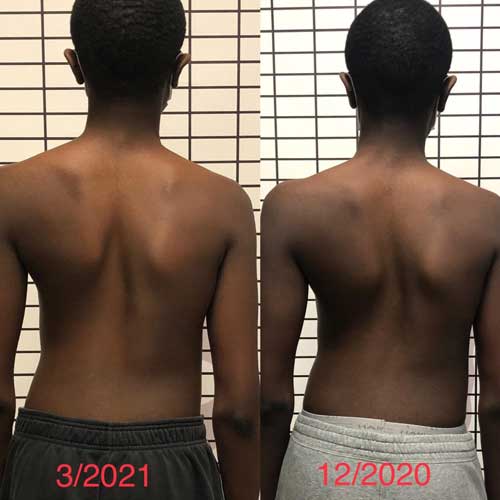 Schroth Method Successful in treating Scoliosis.